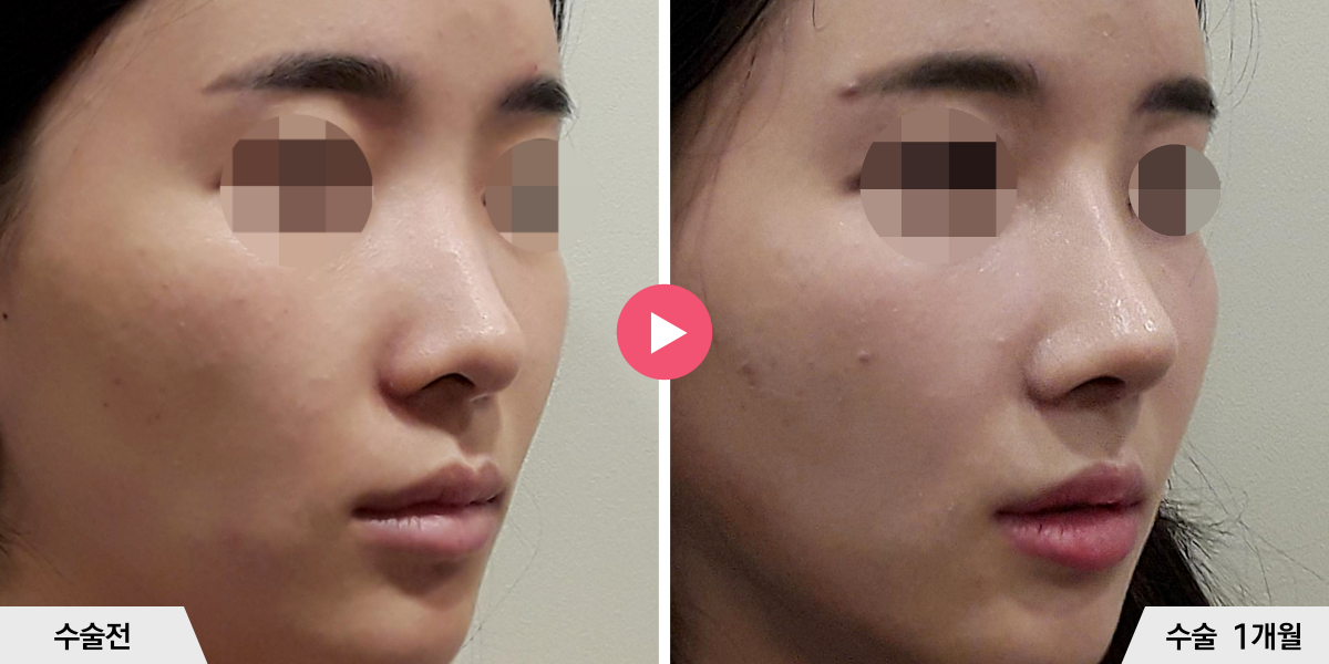 코성형+절골+비공내리기+진피이식