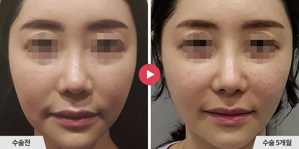 코재수술+비순각교정+진피이식