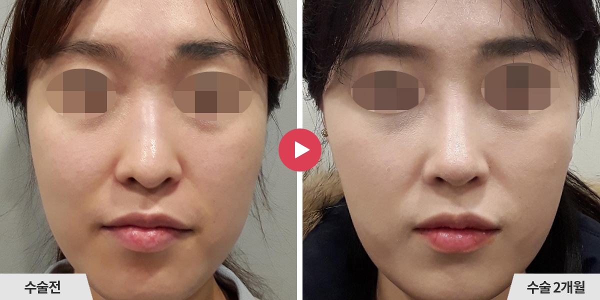 코성형+진피이식+비중격만곡증교정