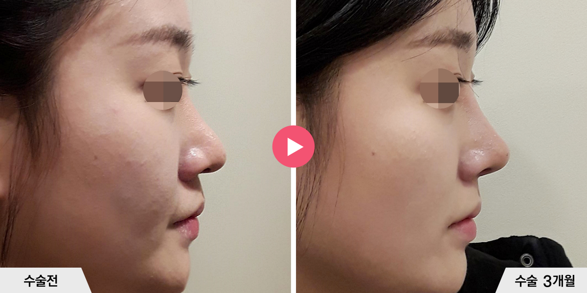 코재수술+비순각교정