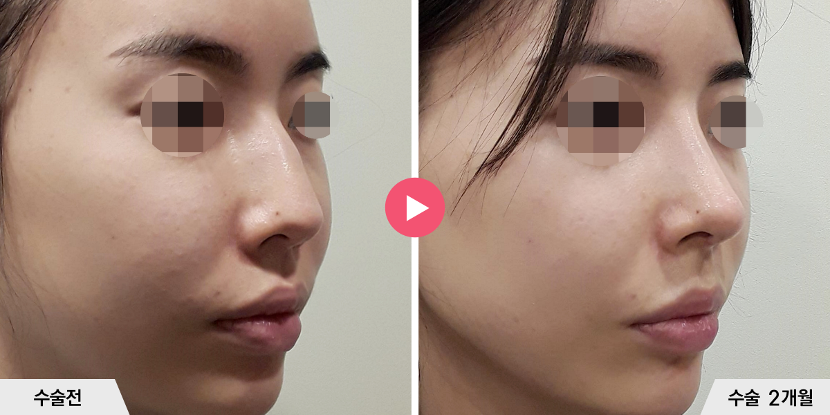 매부리코성형+절골+진피이식