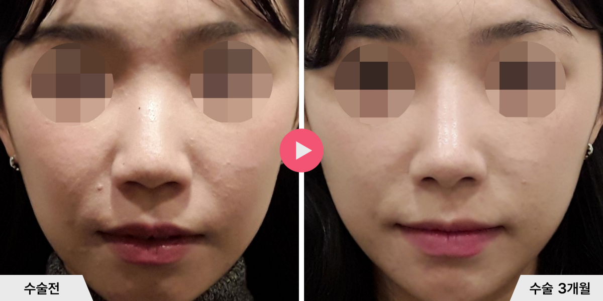 코성형+절골+비순각교정