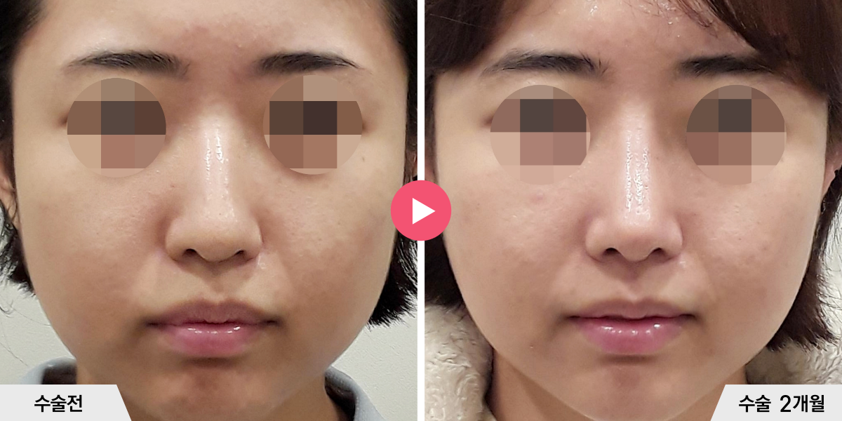 매부리코성형+절골+비중격만곡증교정