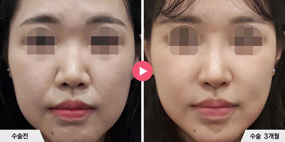 코성형+진피이식+콧볼축소+귀족수술