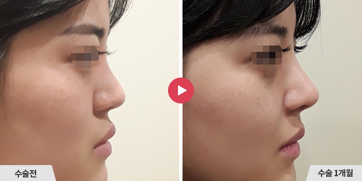 코재수술+비순각교정+콧볼축소+귀족수술