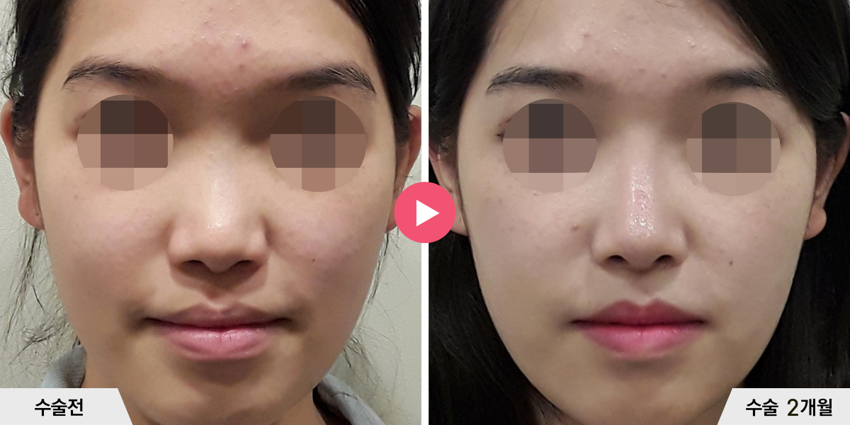 코성형+절골+진피이식