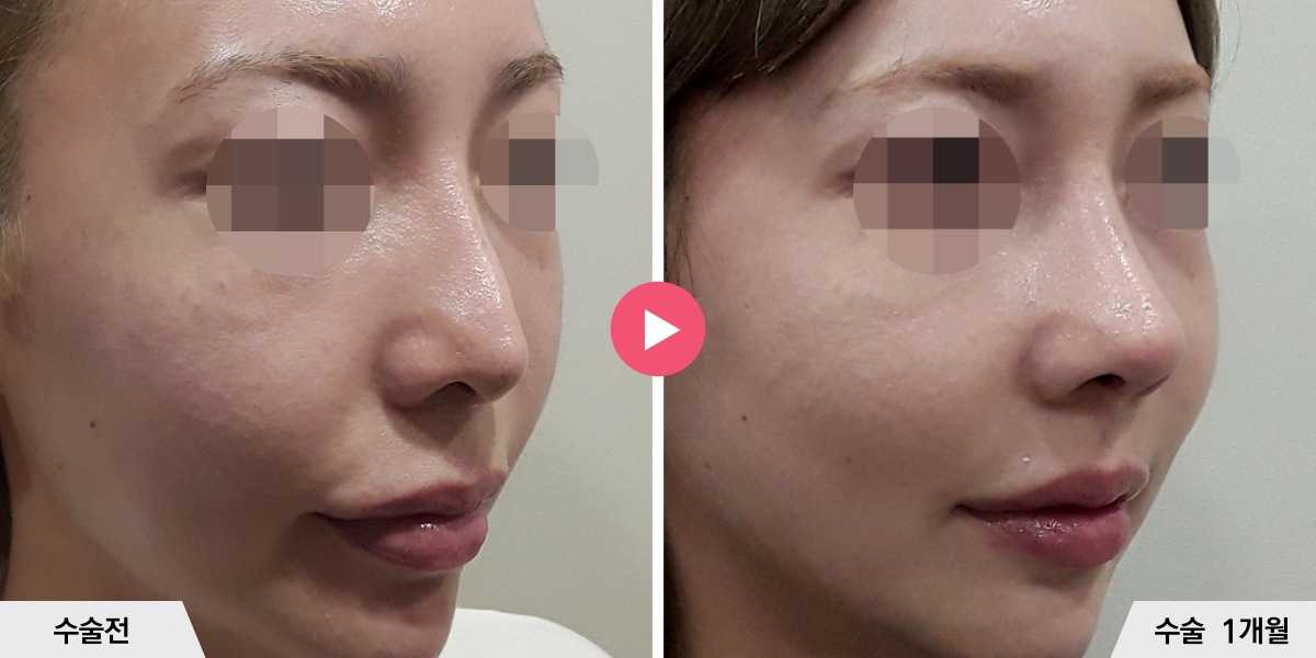 코재수술+절골+비공내리기+진피이식+귀족수술