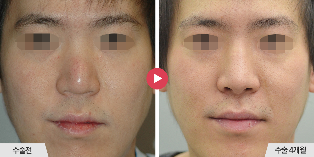 콧등이 매끄럽지 않거나 코끝과의 경계가 표시나는 경우