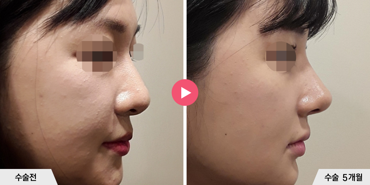 코성형+절골+콧볼축소