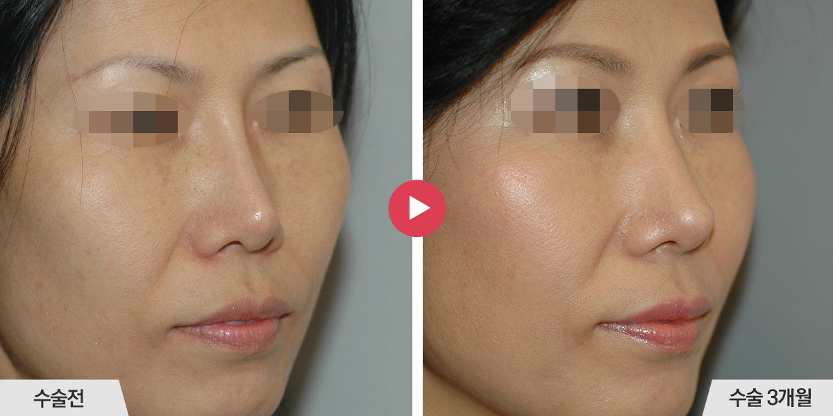 콧등의 폭이 좁은 경우