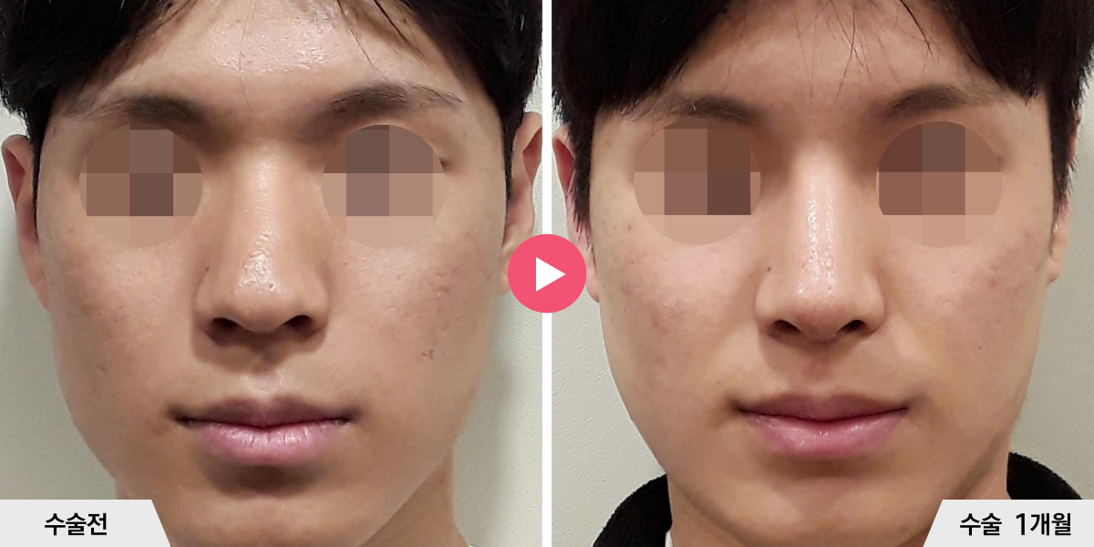 매부리코성형+절골+진피이식+비중격만곡증교정