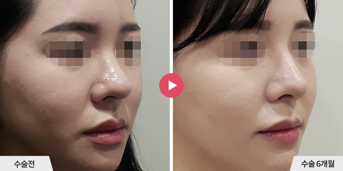 코성형+비순각교정