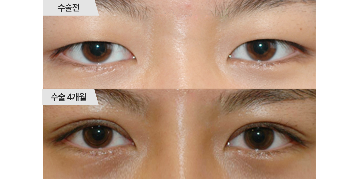 쌍꺼풀 수술, 절개법 & 앞트임 수술