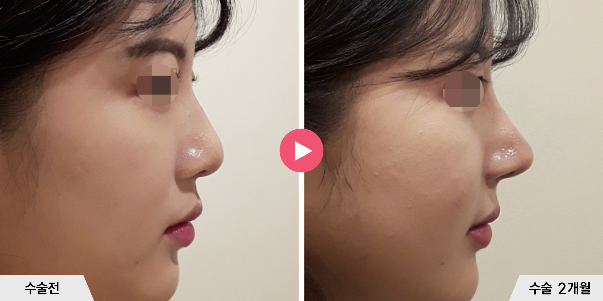 코성형+절골+콧볼축소+귀족수술