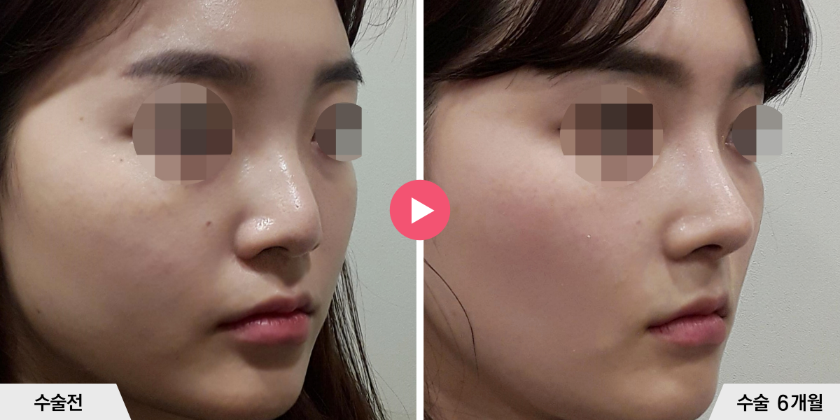 코성형+절골+비순각교정+진피이식