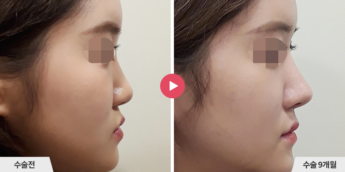 코성형+비순각교정+콧볼축소+귀족수술