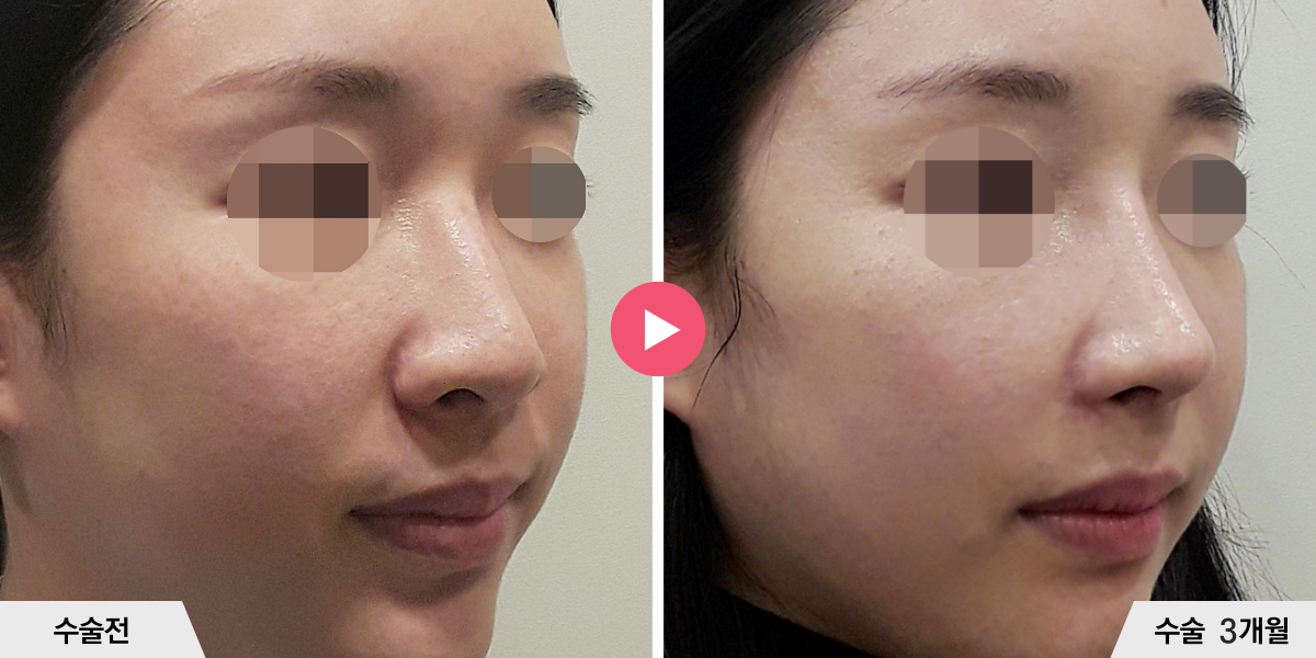 코성형+절골+콧볼축소+귀족수술+비중격만곡증교정