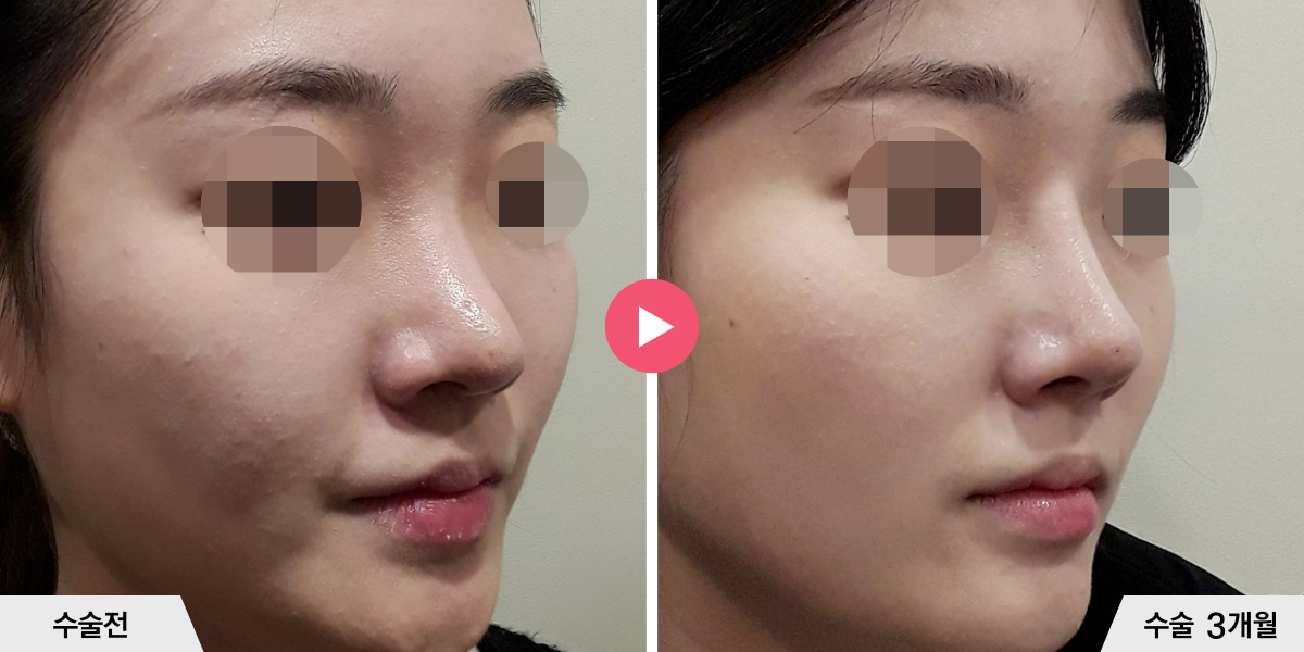 코재수술+비순각교정