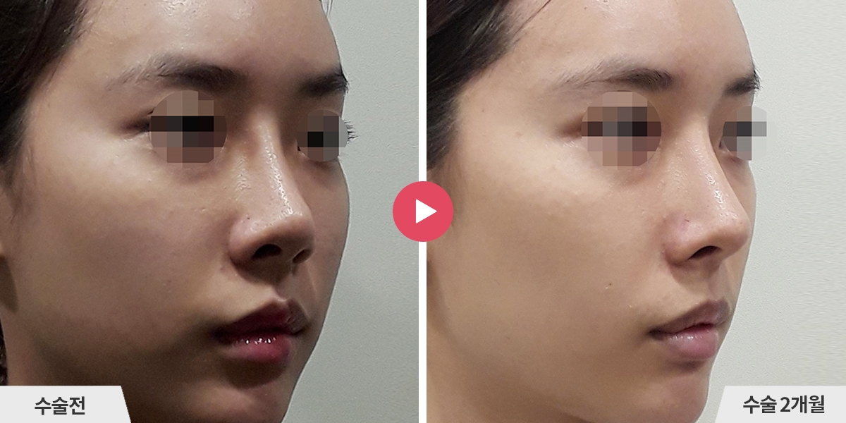 코재수술+비중격만곡증교정