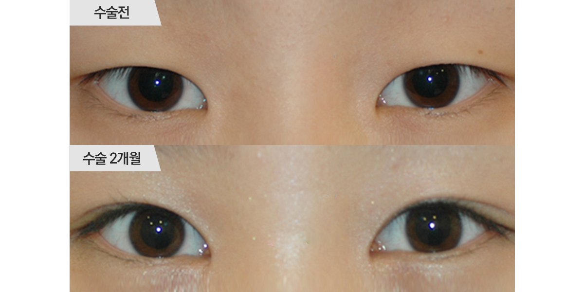 쌍꺼풀 수술, 절개법 & 앞트임 수술