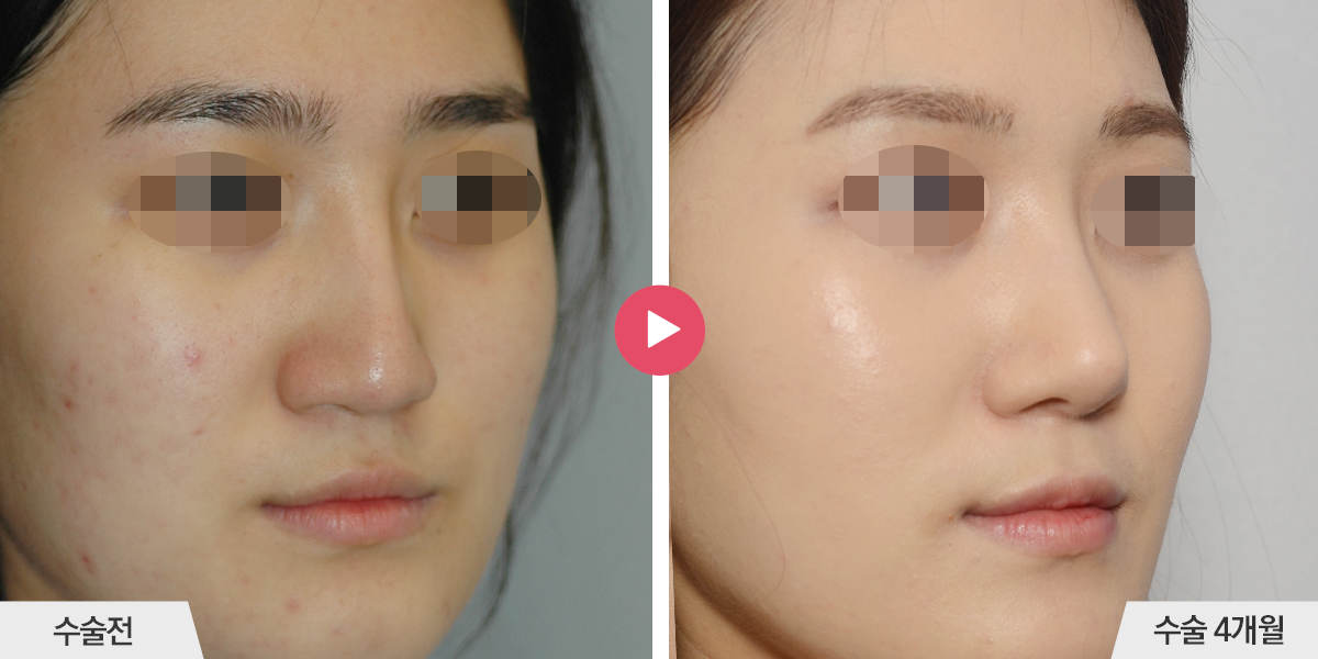 보형물이 삐뚤어진 경우