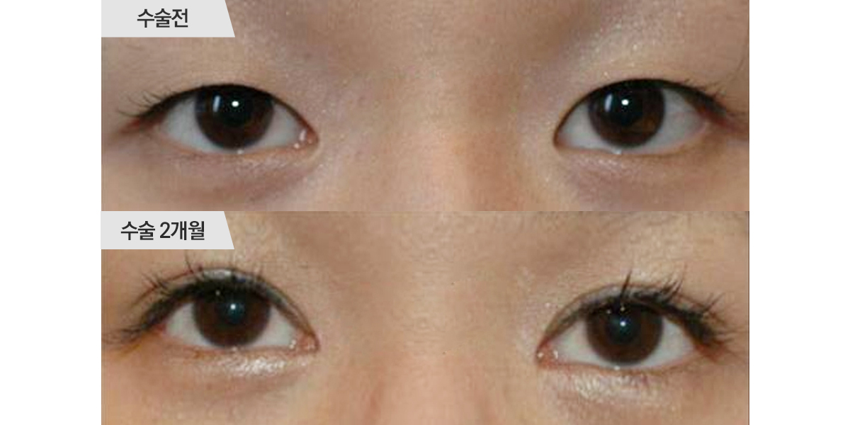 쌍꺼풀 수술, 매몰법 & 앞트임 수술