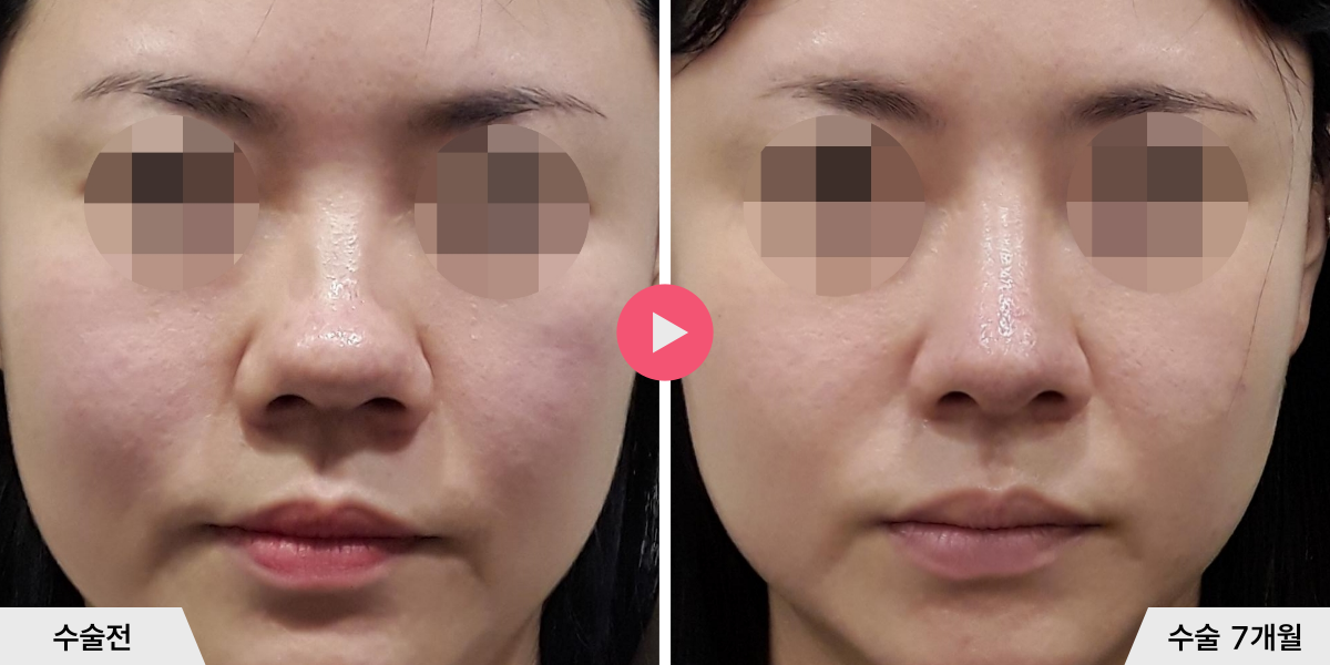 자가늑코성형+비순각교정+비공내리기