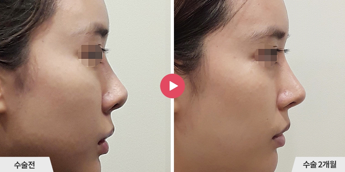 코재수술+비중격만곡증교정