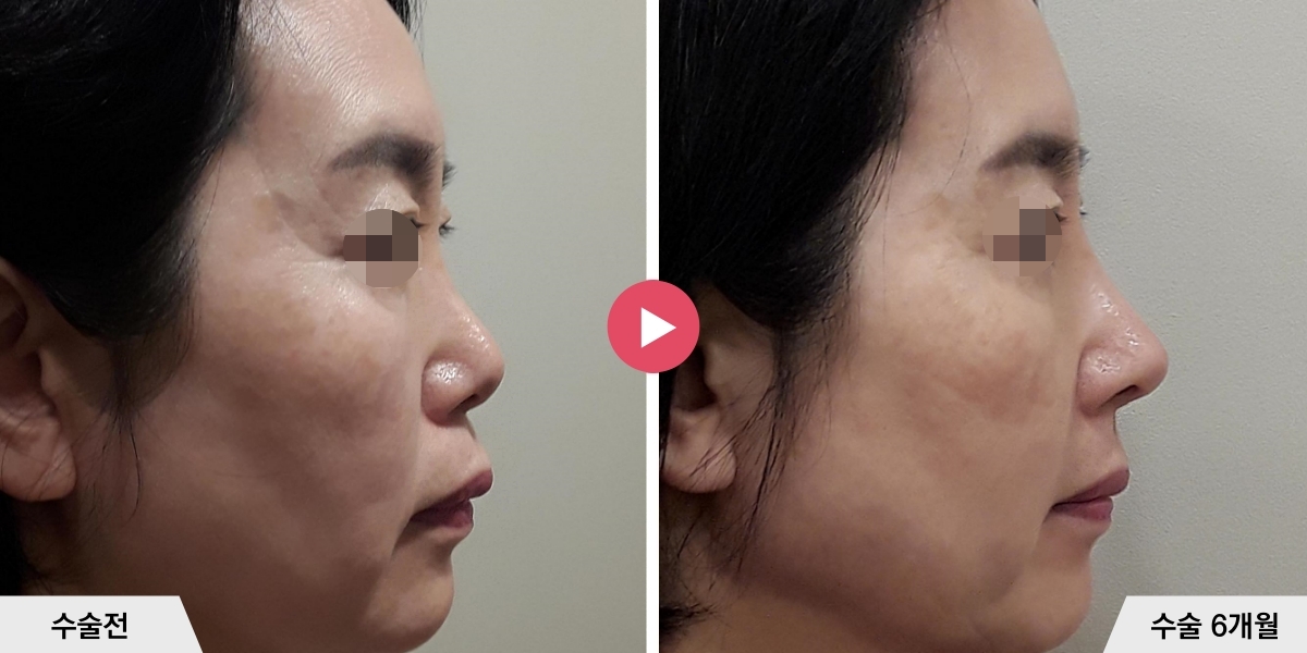 코성형+비순각교정+귀족수술