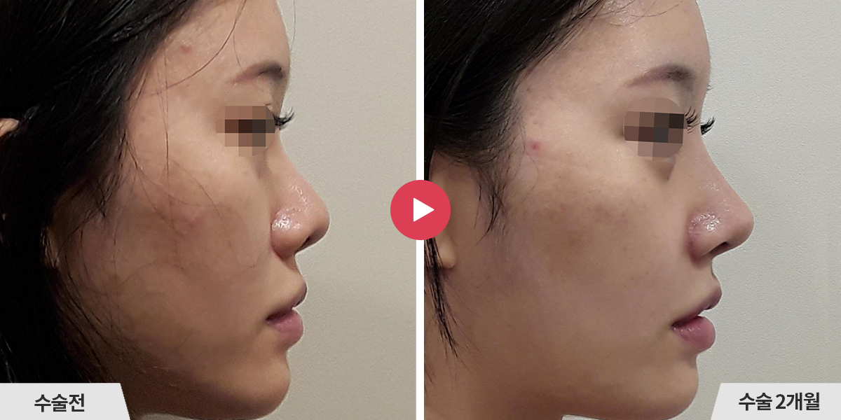 코재수술+비공내리기+비순각교정+콧볼축소+귀족수술