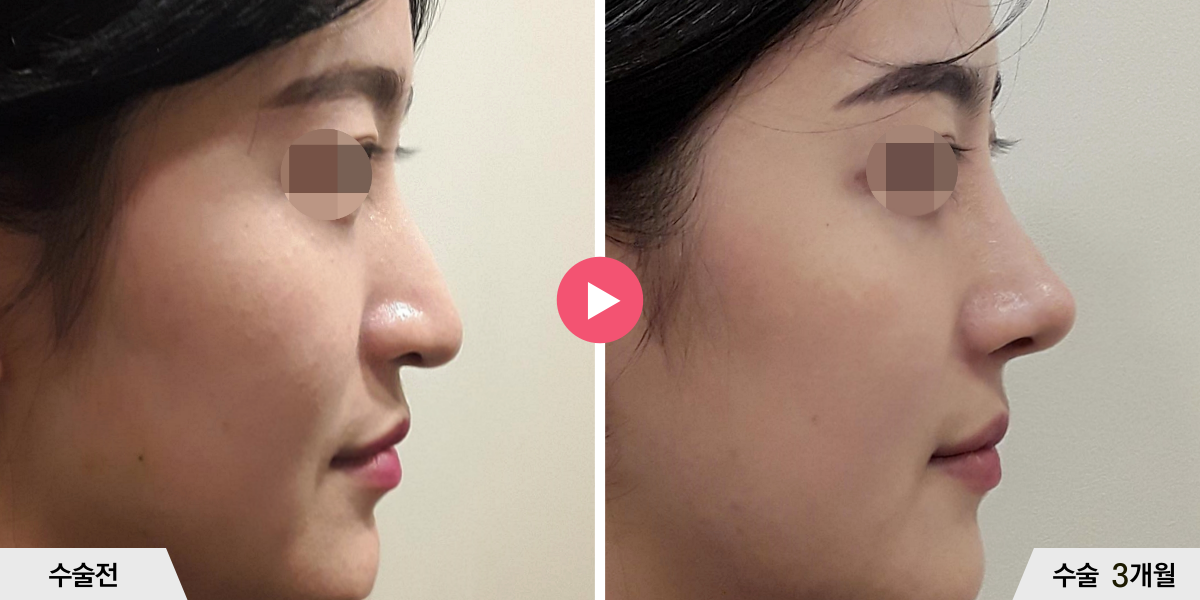 코성형+절골+비순각교정