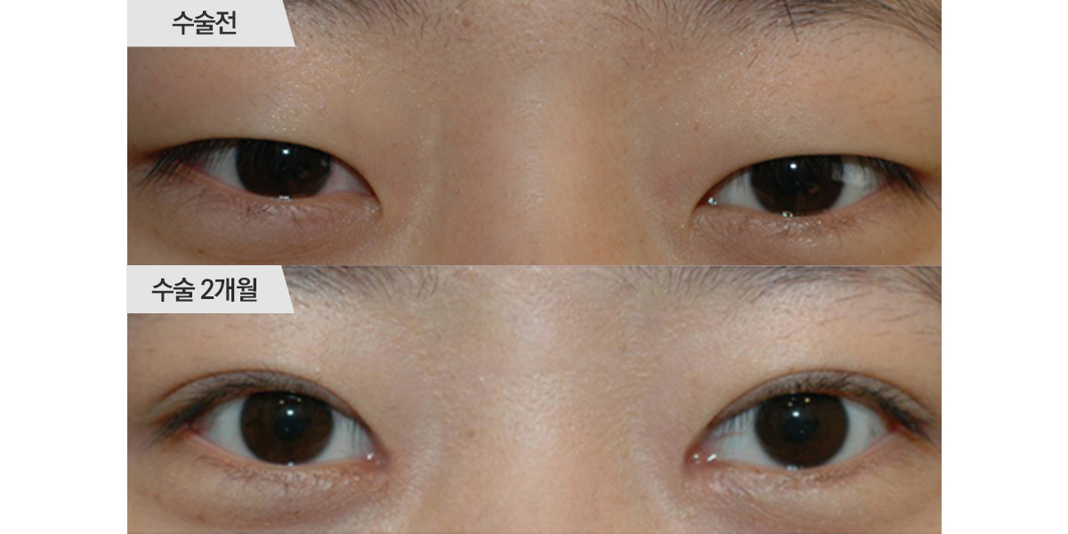 쌍꺼풀 수술, 절개법 & 앞트임 수술