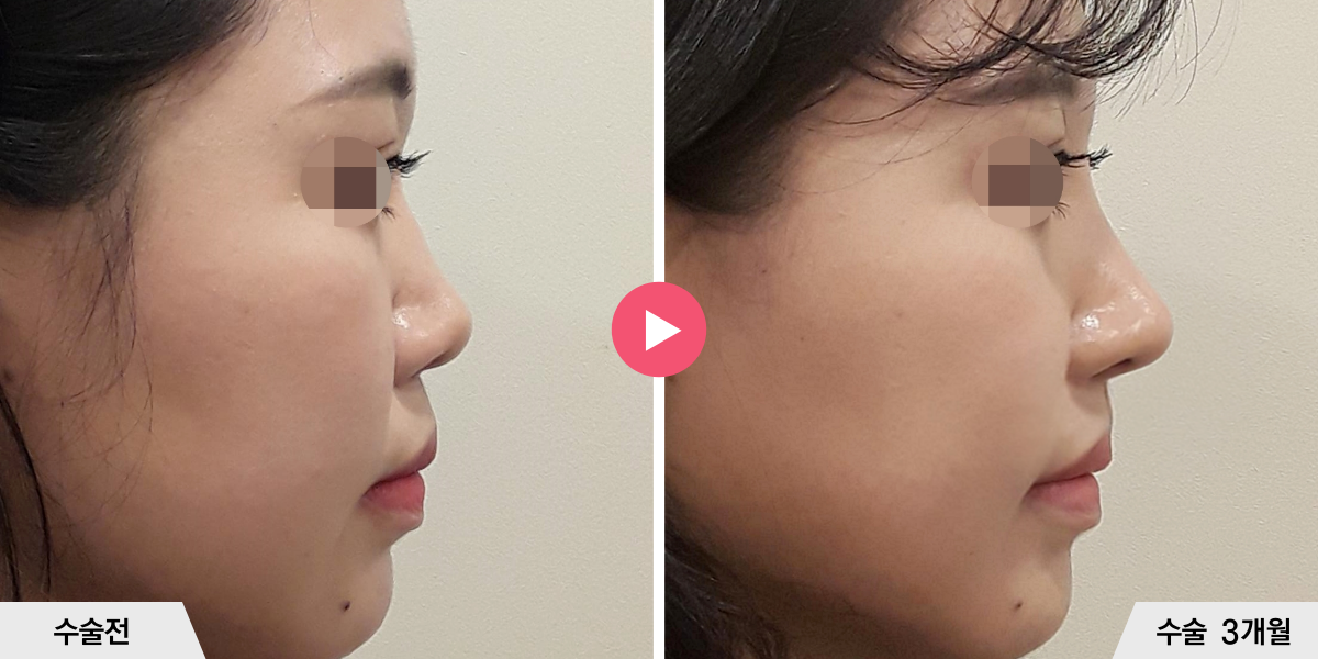 코성형+진피이식+콧볼축소+귀족수술