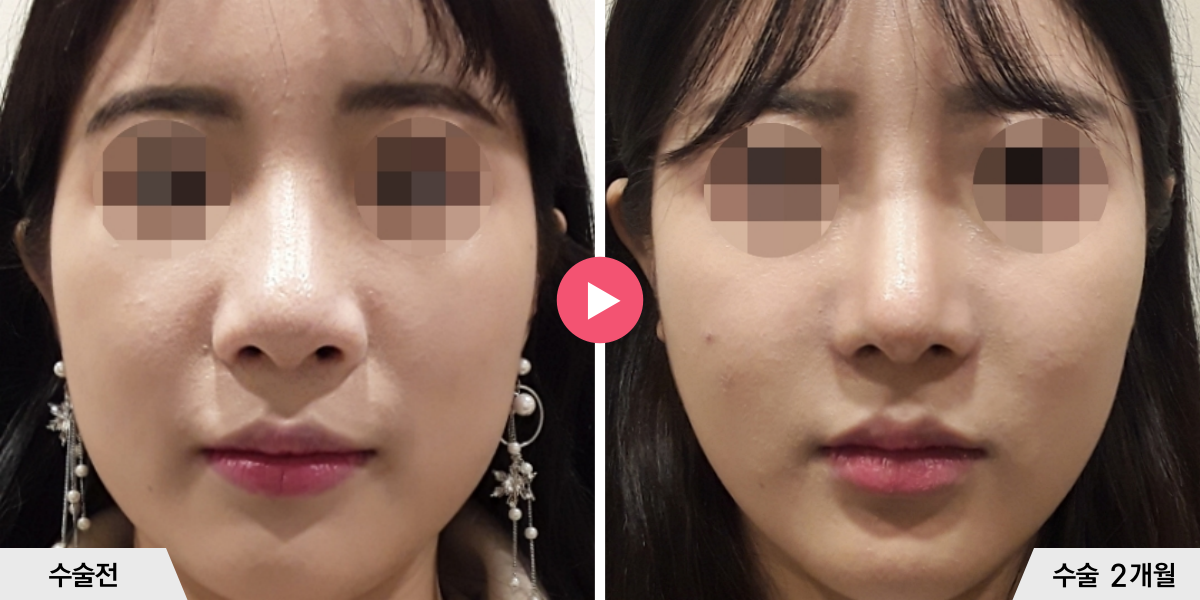 코성형+절골+콧볼축소+귀족수술