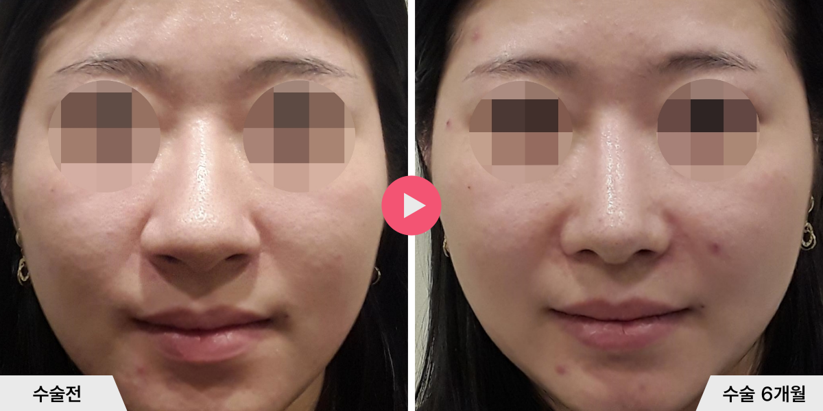 복코성형+절골+콧볼축소