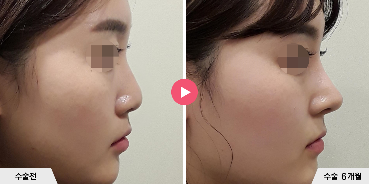 코성형+절골+비순각교정+진피이식