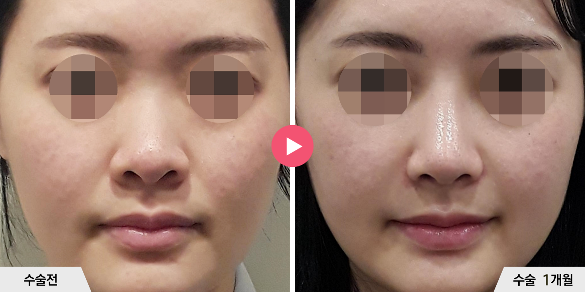 코성형+콧볼축소+귀족수술