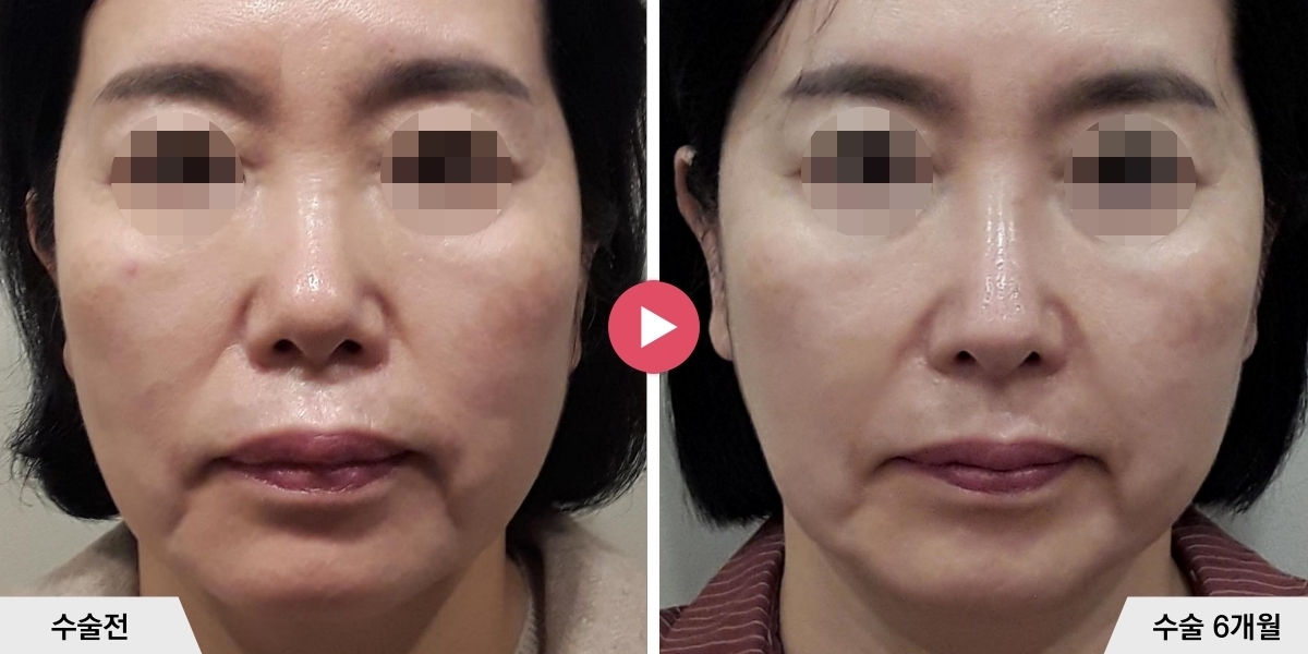 코성형+비순각교정+귀족수술