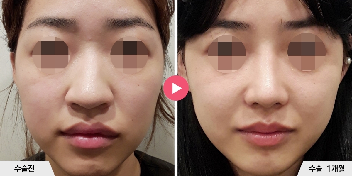 복코성형+비순각교정+콧볼축소+귀족수술