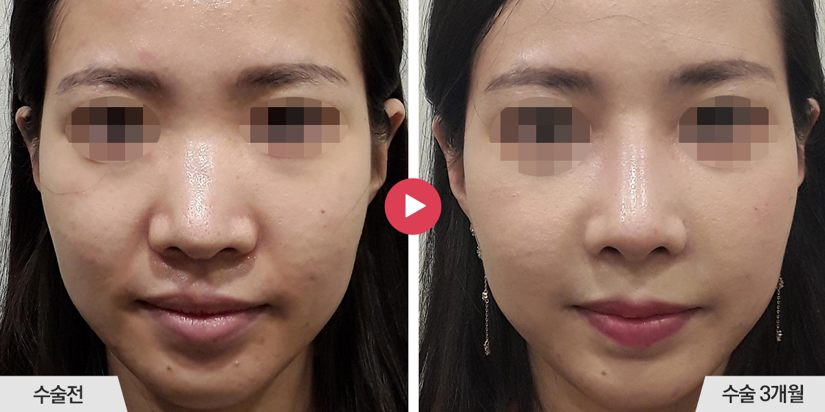 코재수술+절골+비순각교정+콧볼축소+귀족수술