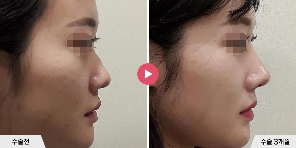 매부리코성형+절골