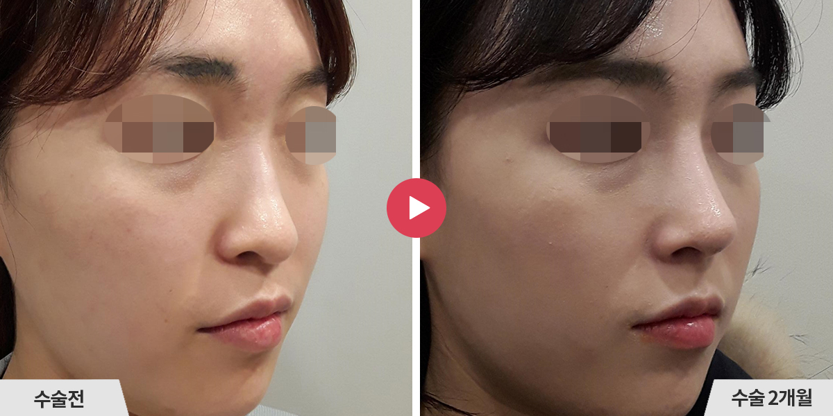 코성형+진피이식+비중격만곡증교정