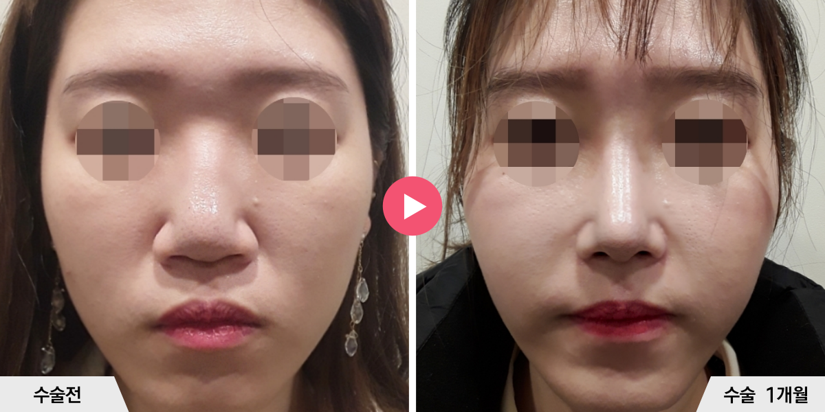 복코성형+매부리교정+비순각교정+콧볼축소+귀족수술