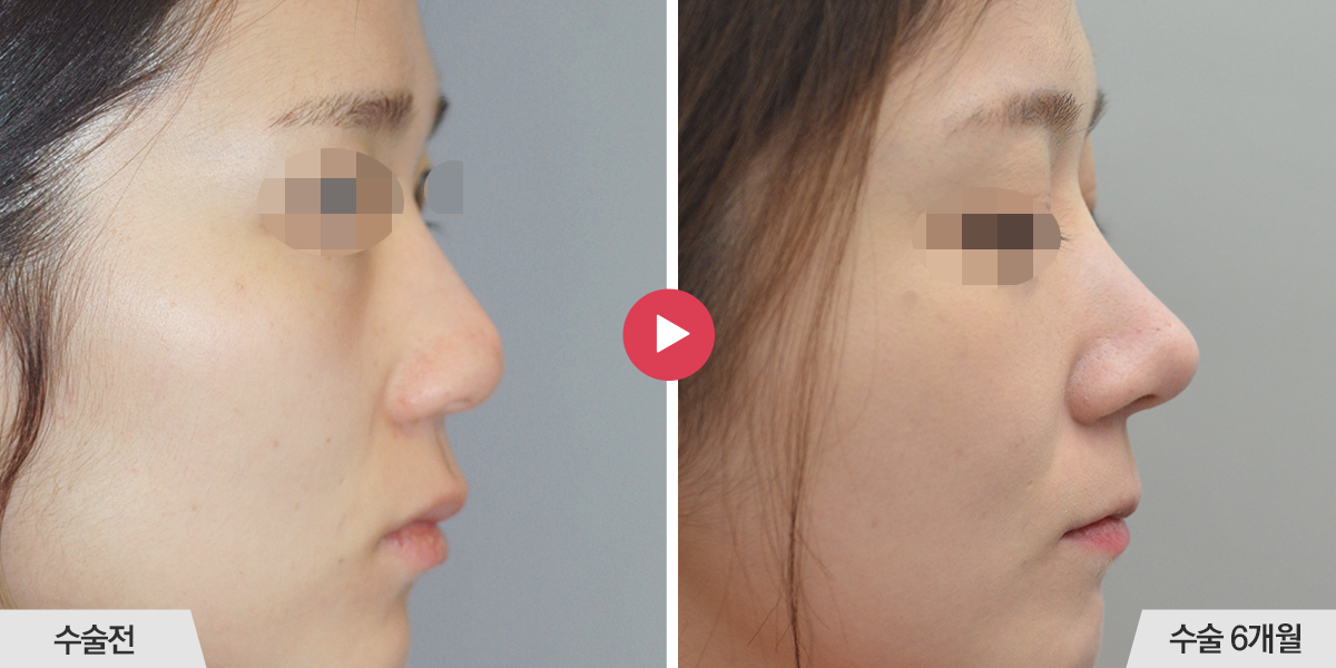 콧등이 넓거나 비대칭인 경우