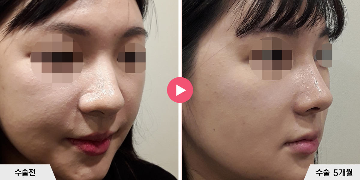 코성형+절골+콧볼축소