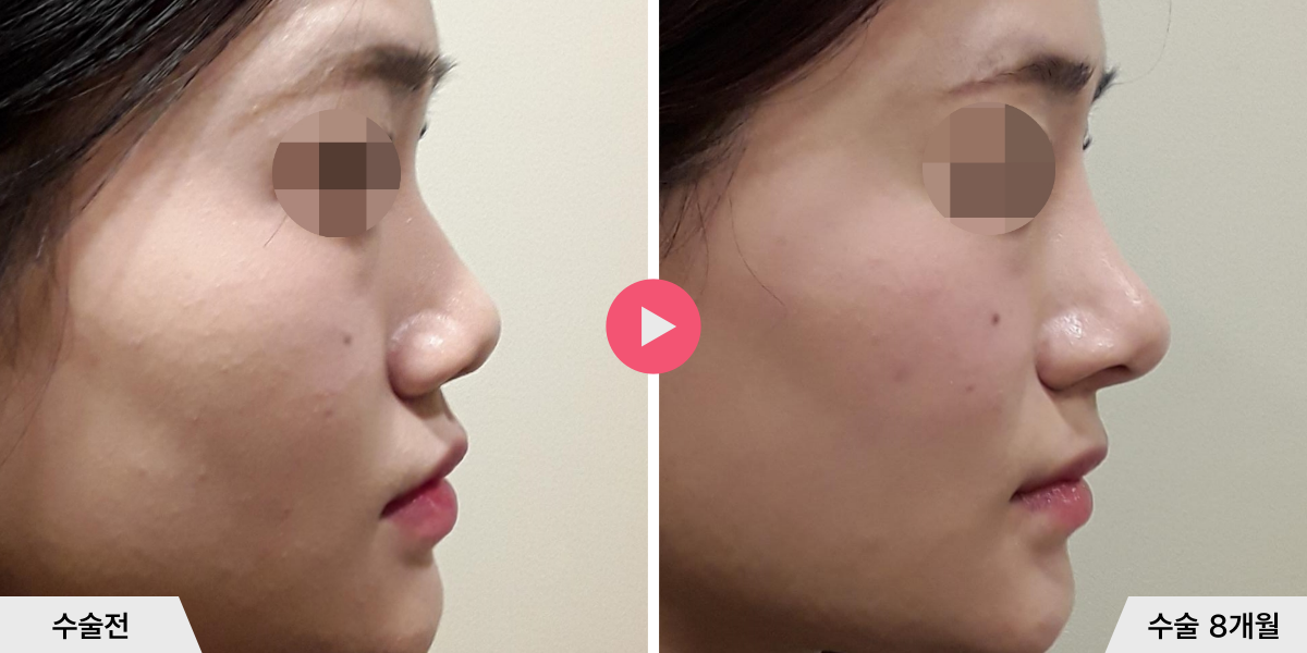 코성형+비순각교정+비공내리기+진피이식