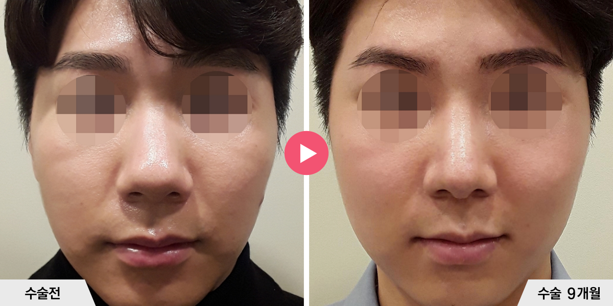 코성형+절골