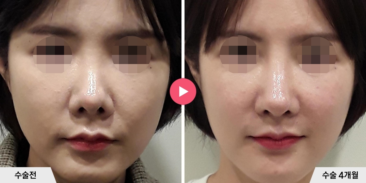 코재수술+절골+비공내리기