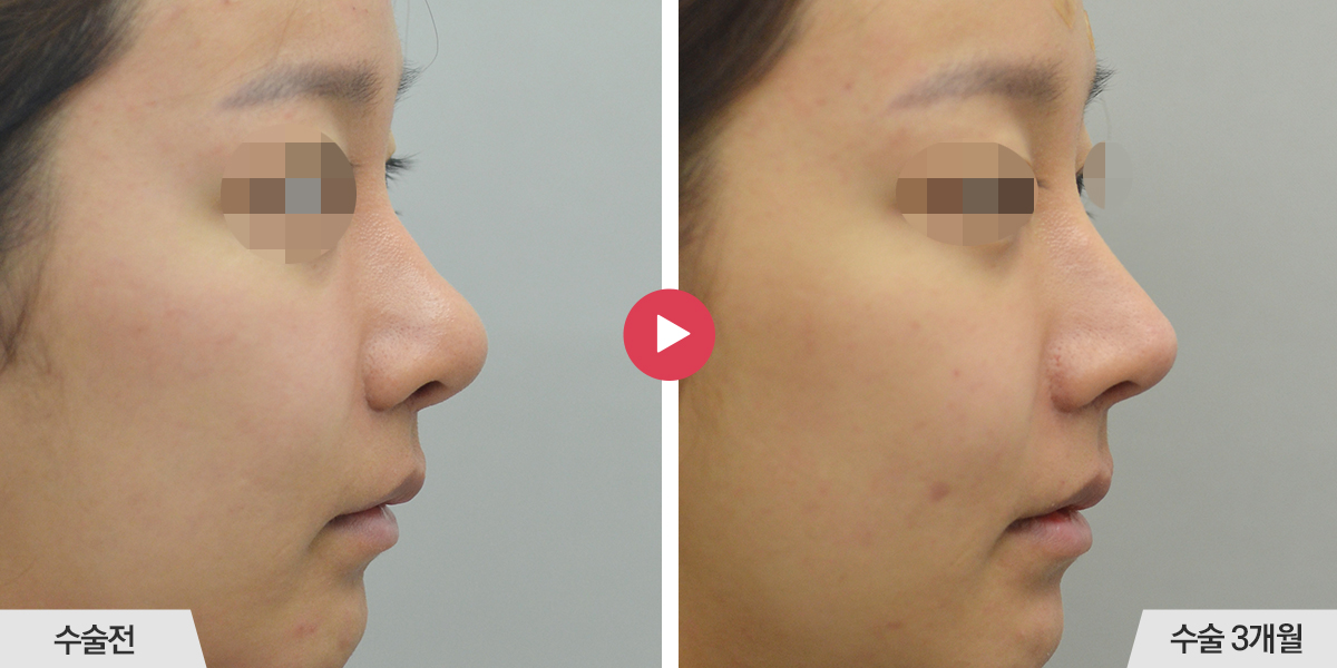 코끝이 뭉툭한 경우(복코 재수술)