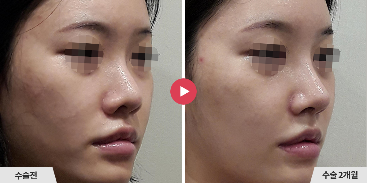 코재수술+비공내리기+비순각교정+콧볼축소+귀족수술